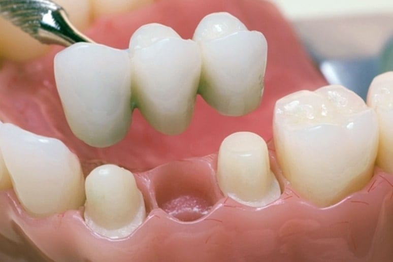 Мостовидные зубные протезы